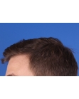 After Hair Transplant&nbsp;Front